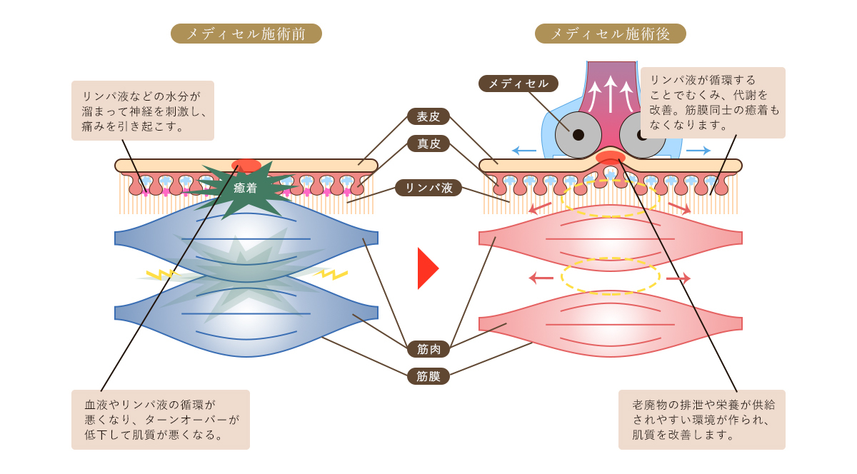 メディセル筋膜美療